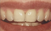 ホワイトニング治療前
